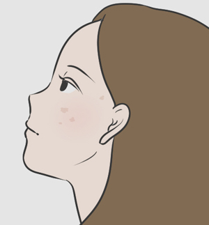 皮膚がんへの不安